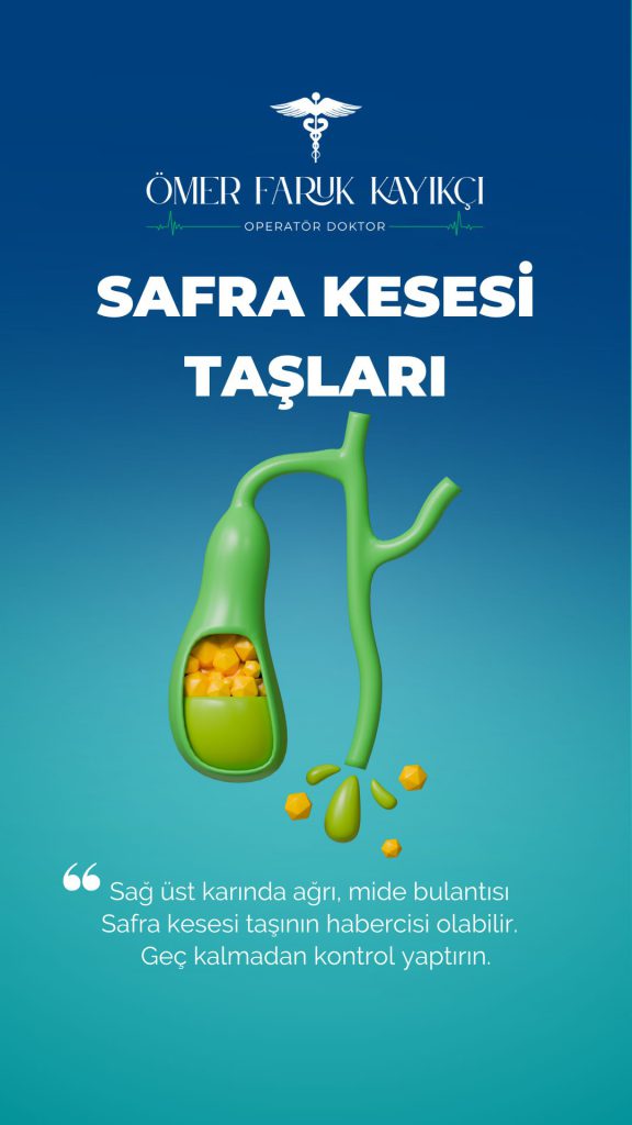 Safra kesesi taşlarını anlatan Instagram hikâyesi